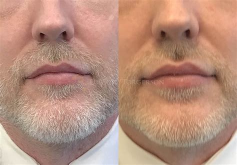 Lip Flip Before & After Gallery | Dr. Cory Torgerson