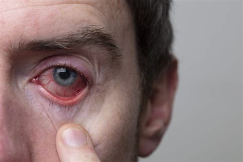 Uveitis – Causes, Symptoms and Treatment – sightconnection