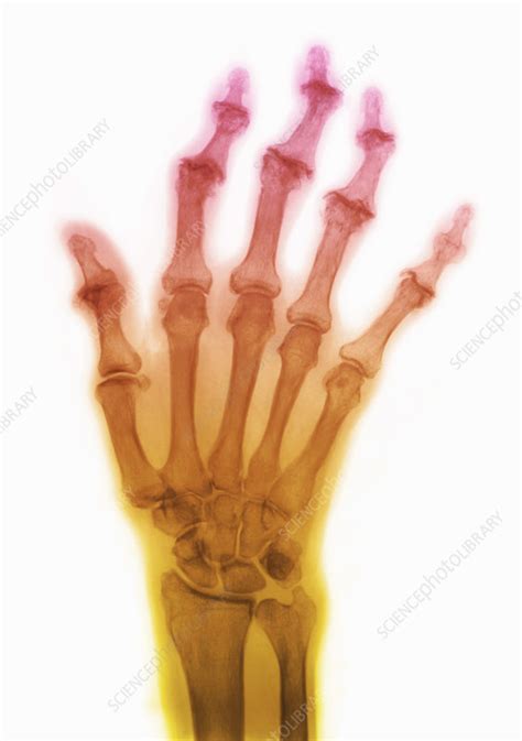 Degenerative Arthritis - Stock Image - C002/9954 - Science Photo Library