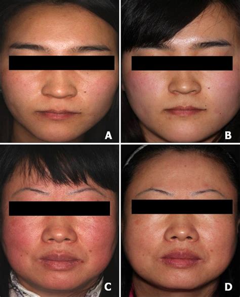 clinical photographic images  mild  moderatesevere groups mild