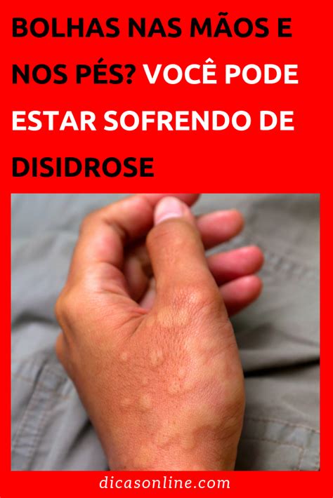 Bolhas Nos Pés E Nas Mãos - Bolhas nas mãos e nos pés podem ser sintomas de disidrose | Tratamento ...