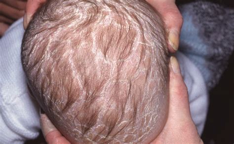 Seborrheic Dermatitis Scalp