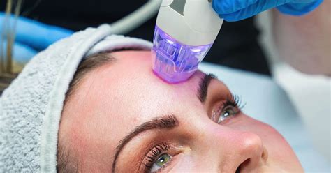 rf microneedling dyson dermatology