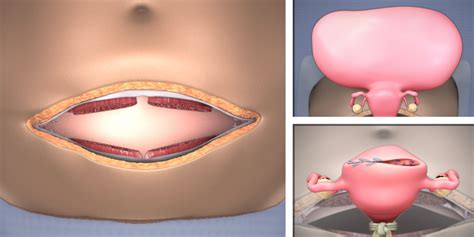 Abdominal myomectomy through Maylard incision - TVASurg - The Toronto ...