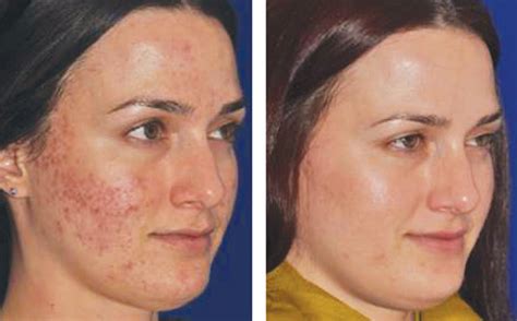 Micro Needling Before And After | Renew Physical Therapy