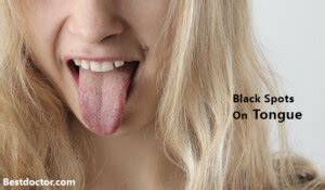 Black Spots On Tongue- Causes, And Tips To Treat