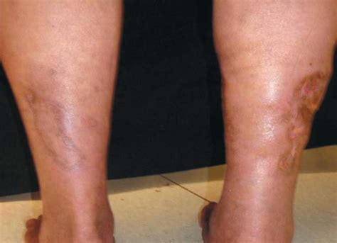 months  starting treatment complete healing  ulcers