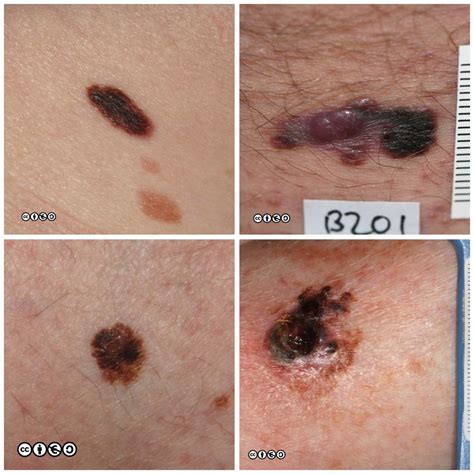nodular melanoma skin cancer malignant melanoma skin cancer pictures