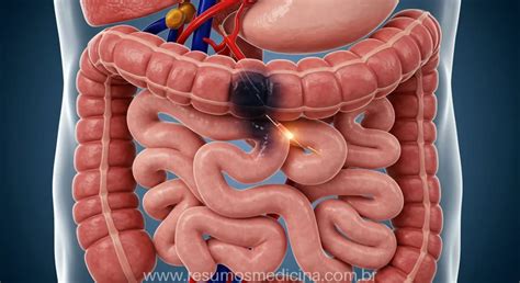 Isquemia Mesentérica É Grave - Isquemia Mesentérica e Abdome Agudo Vascular: Causas, Sintomas ...