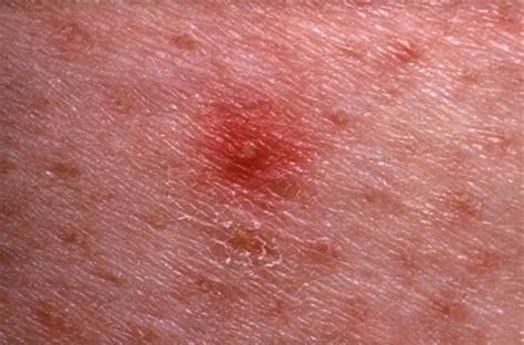 Skin Pathology Commonly Associated With HIV Infection - Infectious ...