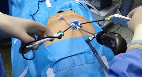 Laparoscopic Surgery – Multispeciality Hospitals in Chennai