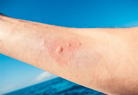 Jellyfish Sting: Treatment and Tips