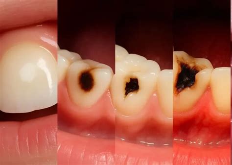Carie No Dente Doi - Fotos de Cárie no Dente em diferentes fases e Como Tratar