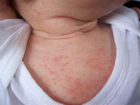 Figure 1. Erythema Toxicum Neonatorum | Baby acne treatment, Baby acne ...