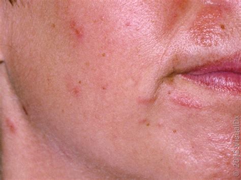 contact dermatitis face treatment
