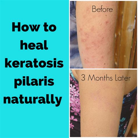 How to treat keratosis pilaris – Artofit