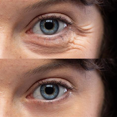 Wrinkle Treatment — Fora Dermatology - General & Surgical Dermatology ...