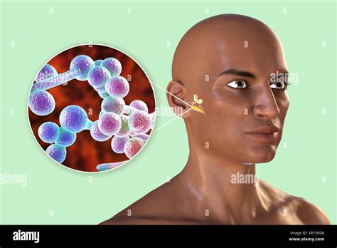 Chronic fungal otitis media ear infection. Computer illustration ...