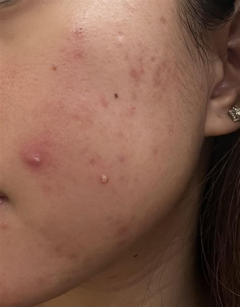 Product suggestions for breakouts ? My skin purges like this usually a