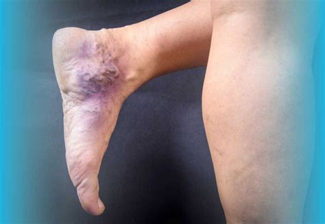 venous leg ulcers richardson healthcare