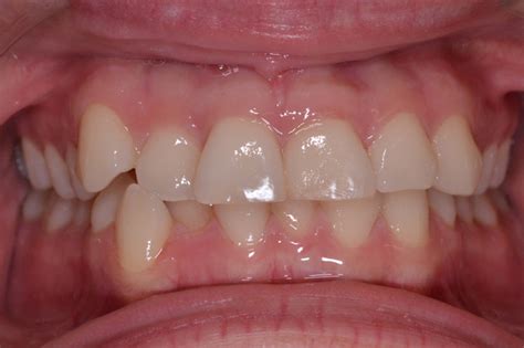 avant apres orthodontie orthodontie des laurentides  st jerome