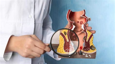 types  fistulas  comprehensive guide