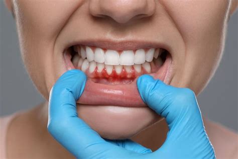 Periodontia O Que Trata - Periodontia: O Guia Completo para Prevenir e Tratar Doenças ...