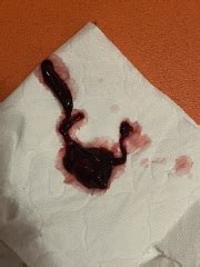 implantation bleeding  miscarriage mumsnet