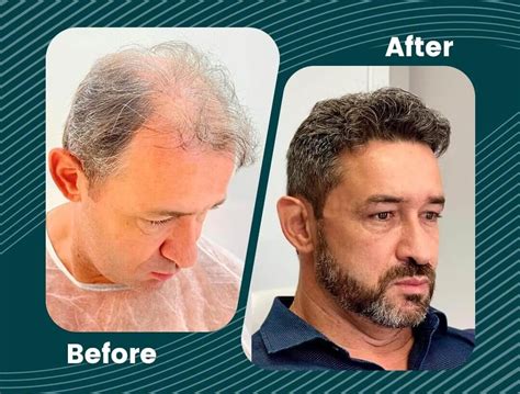 sapphire fue hair transplant turkey medprime clinic