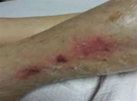 Skin Failure - Introduction and Assessment