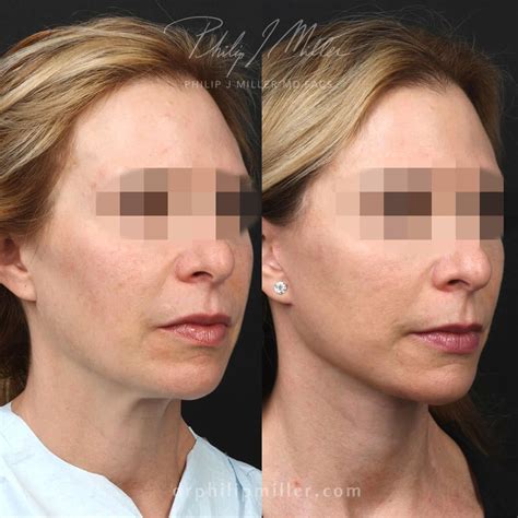 Mini Facelift in New York City - Philip Miller MD