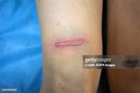 fake scars stock  high res pictures  images getty images