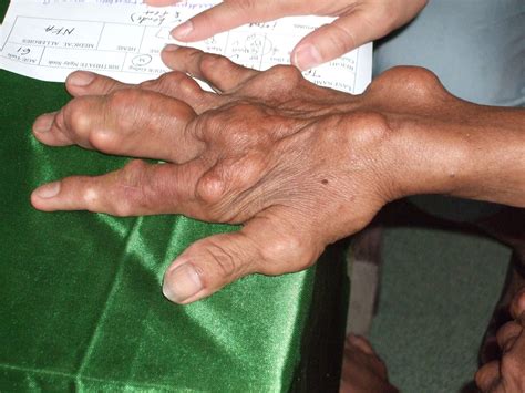 pin  disfigured people