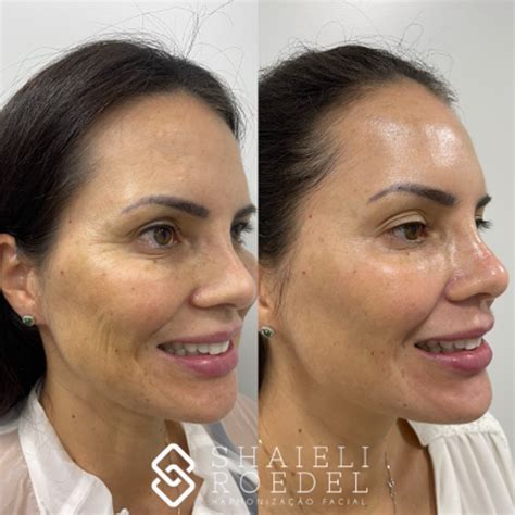 Antes E Depois Ultraformer - Ultraformer 3: antes e depois