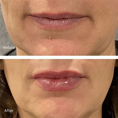 Lip Fillers in Denver NC Injectable Derma Lip Fillers