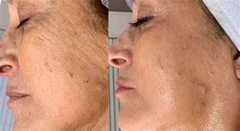 Cryoskin Treatment: Full Review & Reasons To Do (Or Not) | Heliotherapy ...