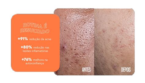 Acnezil Pomada Antes E Depois