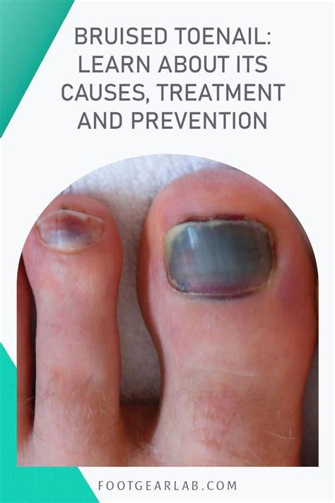 Bruised toenail learn about its causes treatment and prevention – Artofit