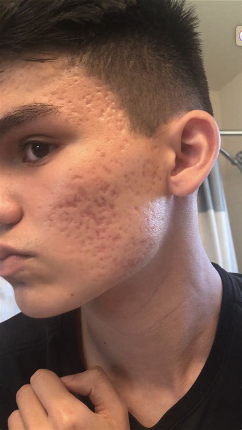 Severe acne scarring :( – Scar treatments – Acne.org Forum