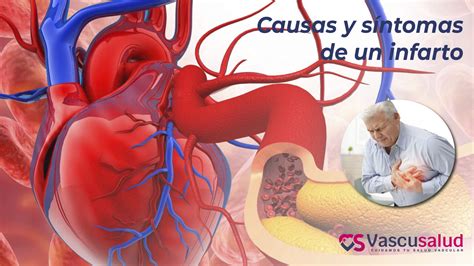 causas  sintomas de  infarto