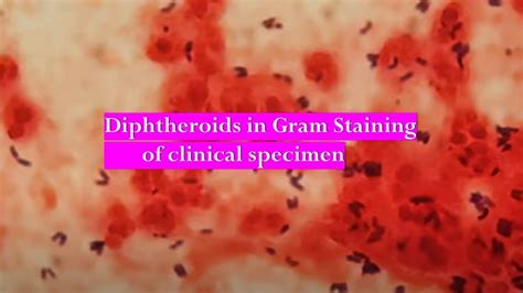 Diphtheroids as pathogen in Gram Staining of Sputum of Older Patient - YouTube