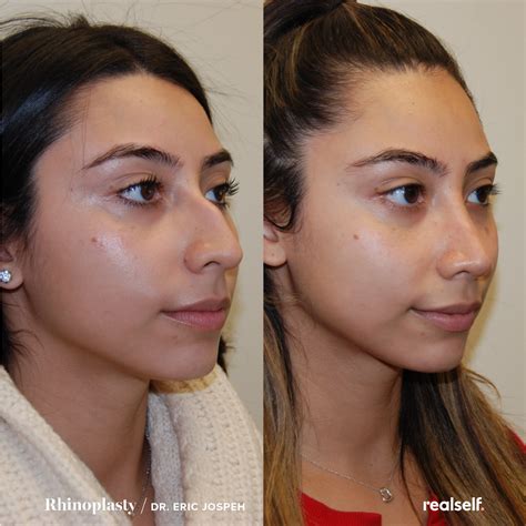 Nose Job Recovery Timeline