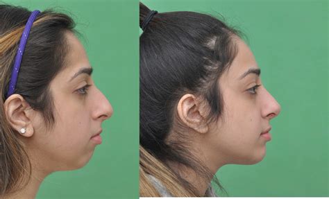 Chin Implant Gallery - Top Plastic Surgeon In McLean, VA