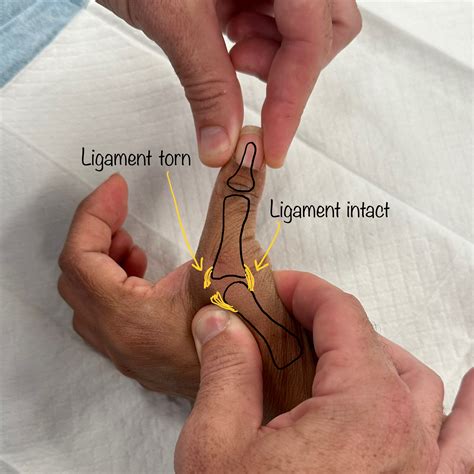 Ulnar Collateral Ligament Rehabilitation