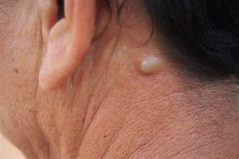 Bumps on Neck: What Neck Bumps Can Really Mean