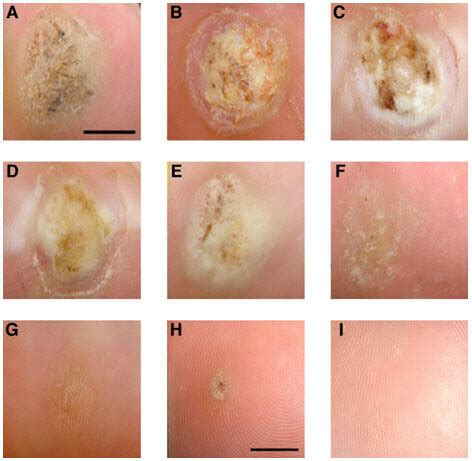 Salicylic Acid Plantar Wart Removal Stages | Bruin Blog