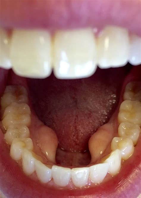 Maxillary And Mandibular Tori