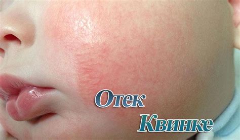 Отек квинке: симптомы и лечение у взрослых и детей в домашних условиях