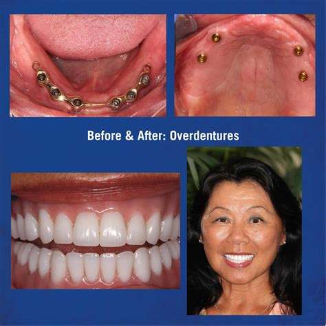 implant supported upper dentures