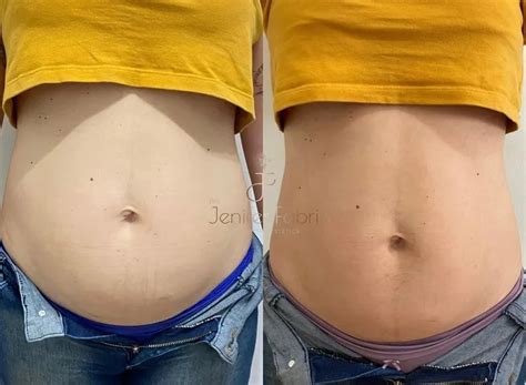 Hidrolipo Flancos Antes E Depois - Hidrolipo: Antes e depois – Antes da Fama